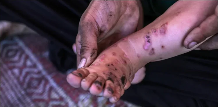 غزہ میں چوہوں اور کیڑے مکوڑوں سے جلدی بیماریاں تیزی سے پھیل رہی ہیں